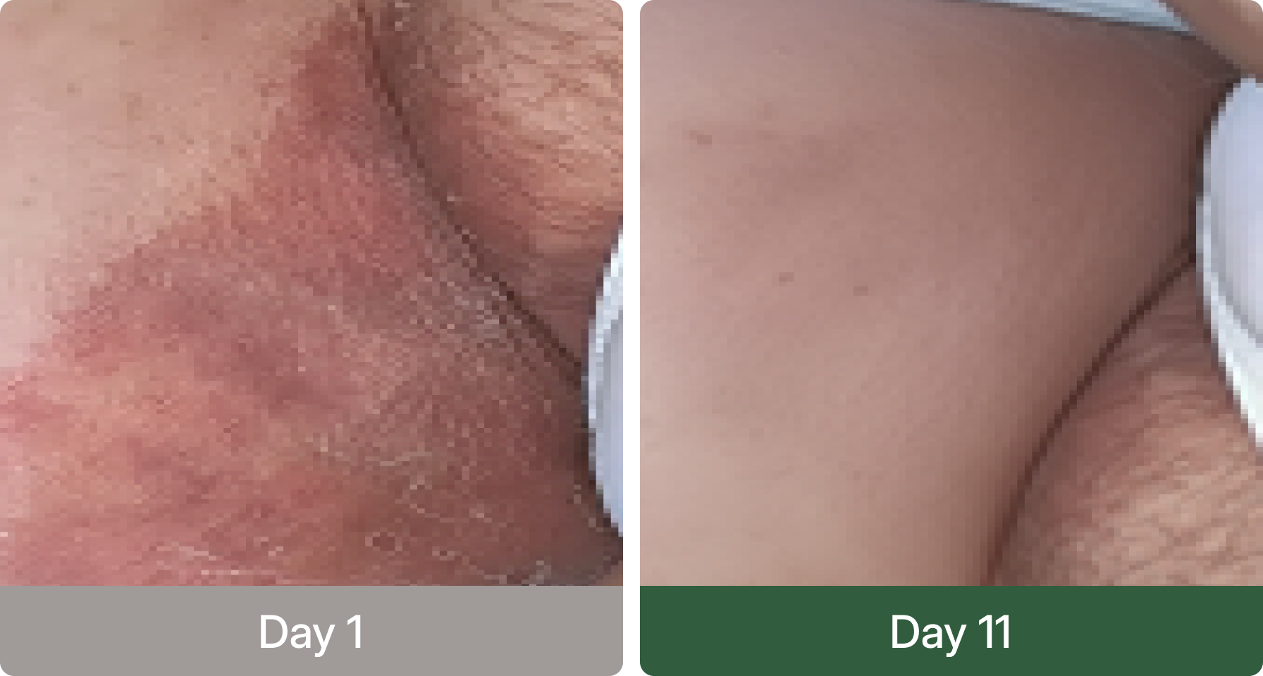 Before and after using Norqez - Day 1 vs Day 11