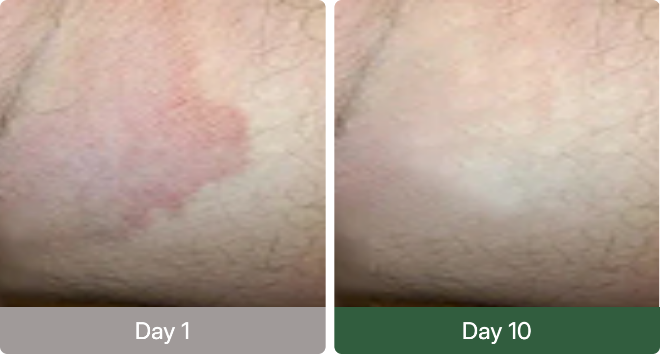 Before and after using Norqez - Day 1 vs Day 10