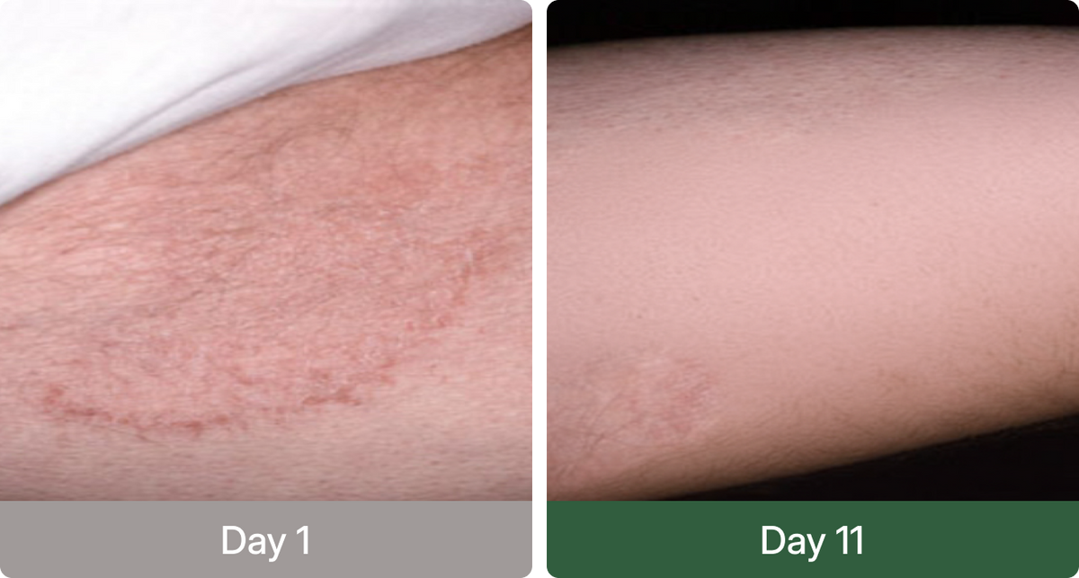 Norqez Antifungal Soap