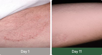 Norqez Antifungal Soap